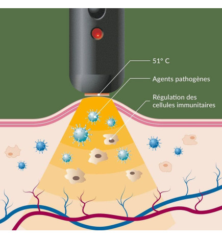 Herpotherm – Stylo chauffant Neo, soin herpès labial et boutons de fièvre