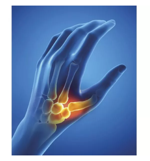 Epitact – Orthèse de pouce nuit thermoformable rigide main gauche taille M, 1 unité