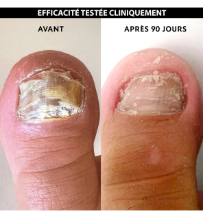 Alvadiem – Ongles Jaunis Soin Assainissant, 10 ml
