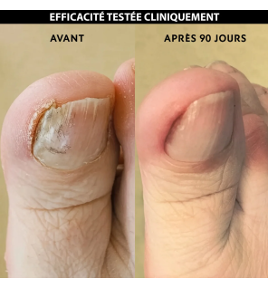 Alvadiem – Ongles Jaunis Soin Assainissant, 10 ml